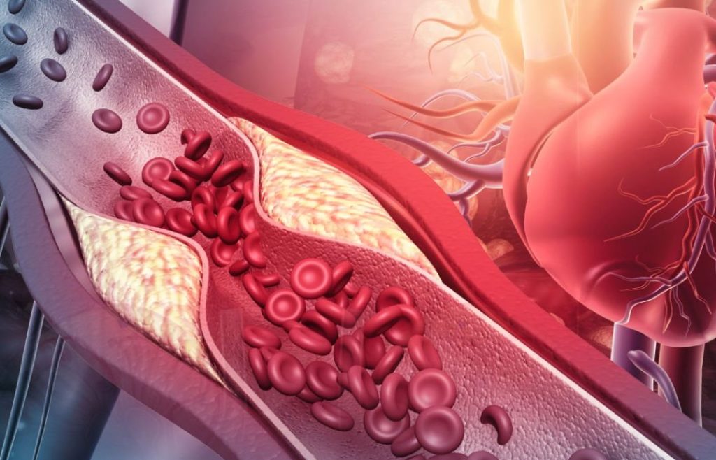 hipertension arterial - placa de ateroma